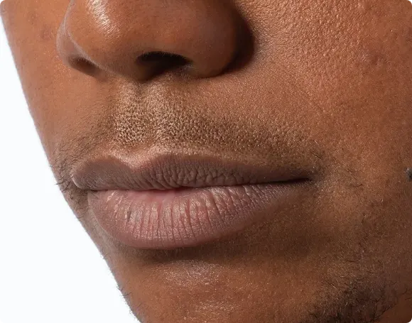 Before laser hair removal at Riolaser
