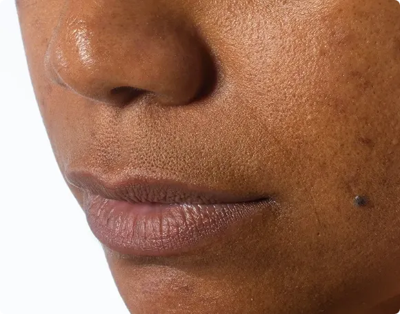 After laser hair removal at Riolaser
