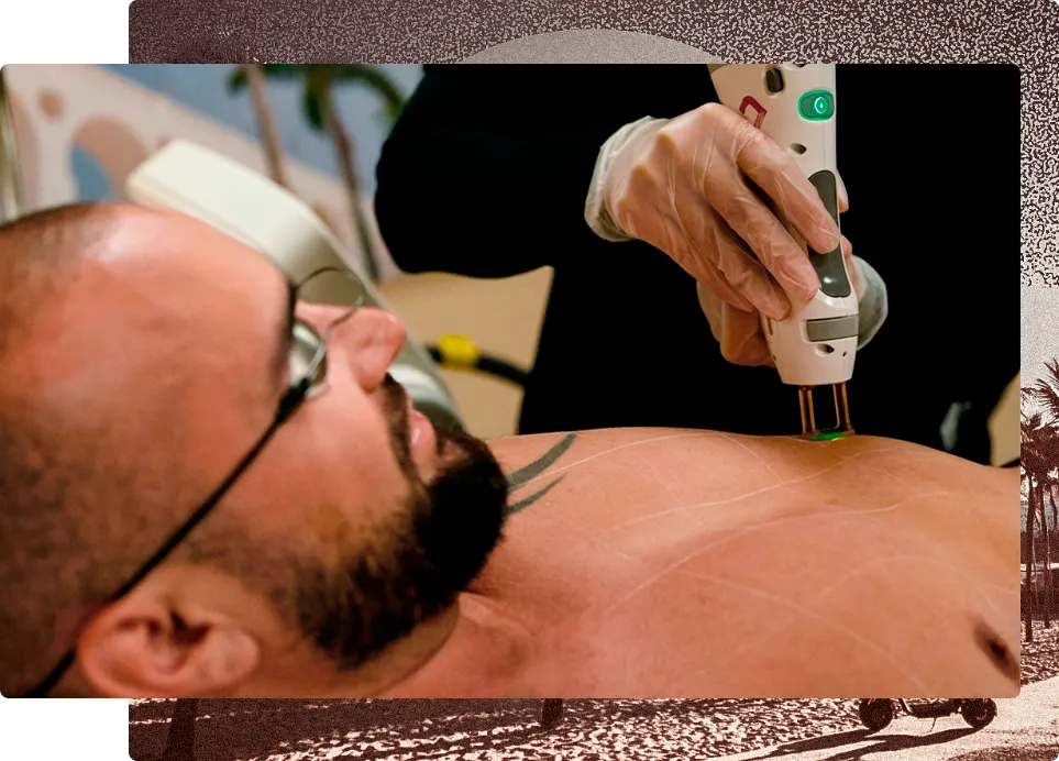 Laser hair removal on chest and stomach
